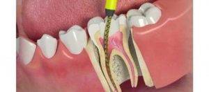 root canal in dubai
