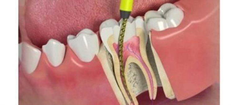 root canal in dubai